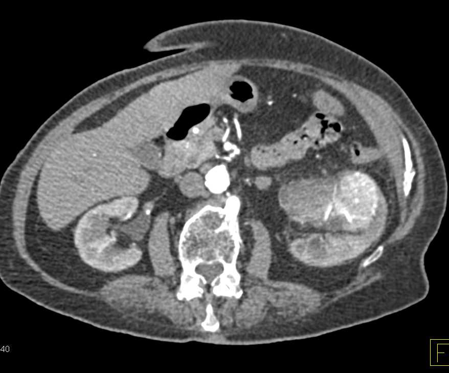 Clear Cell Renal Cell Carcinoma Left Kidney - CTisus CT Scan