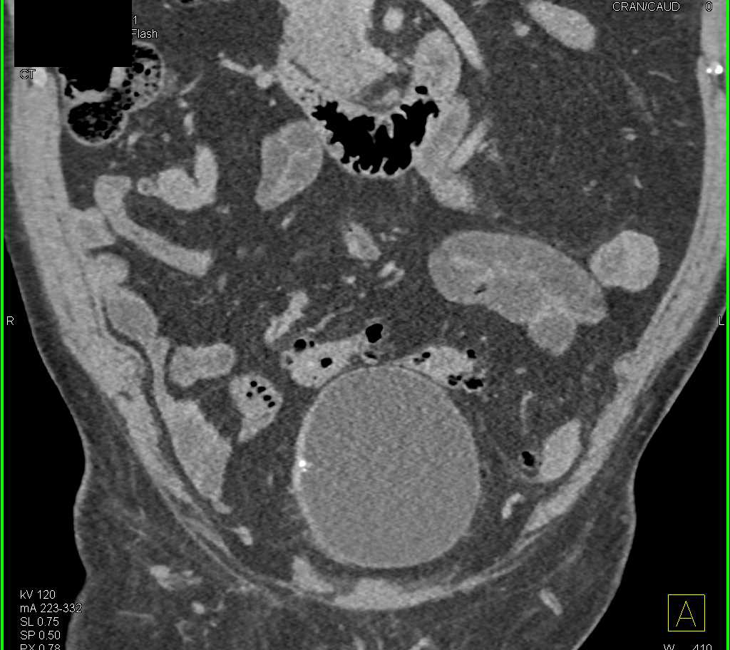 Subtle Carcinoma of the Right Wall of the Bladder - CTisus CT Scan