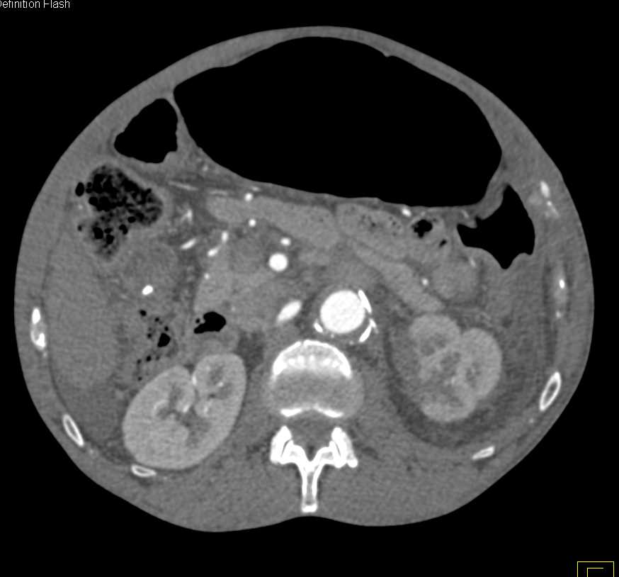 Infarct Left Kidney in Patient with Vascular Reconstructive Surgery - CTisus CT Scan