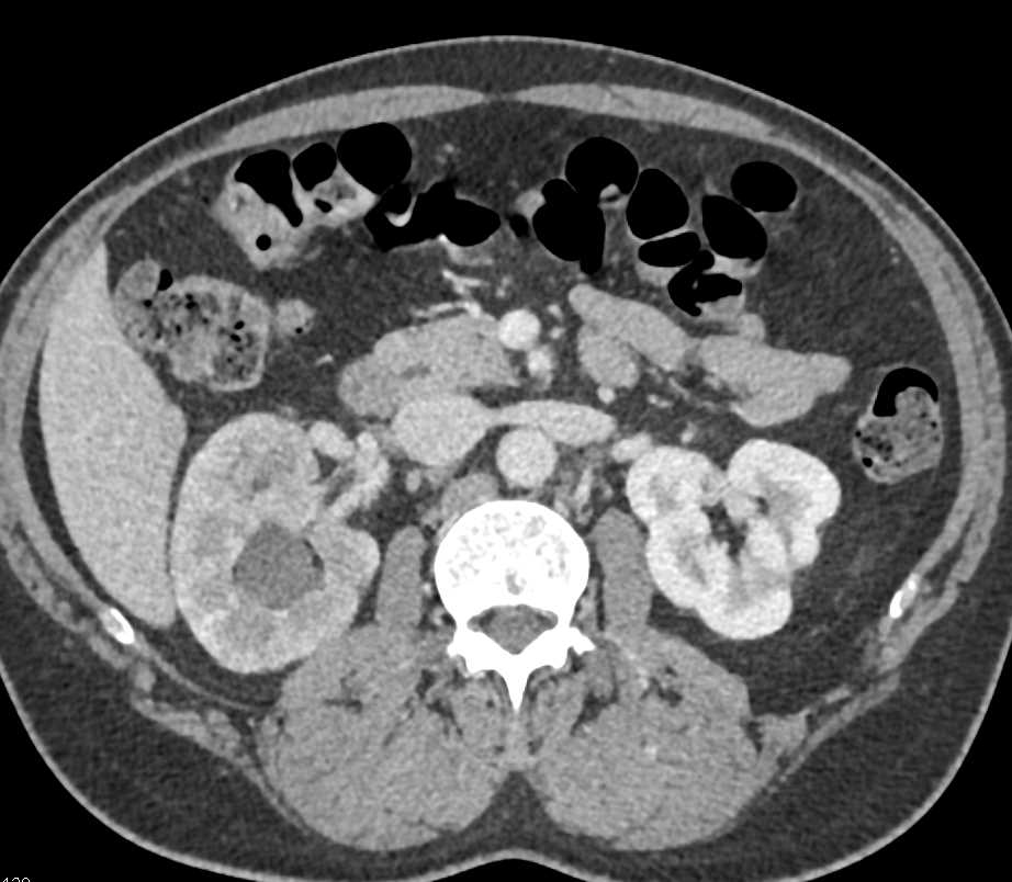 Transitional Cell Carcinoma Right Kidney - CTisus CT Scan