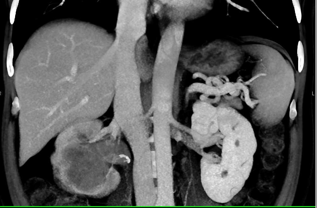 Transitional Cell Carcinoma Right Kidney - CTisus CT Scan