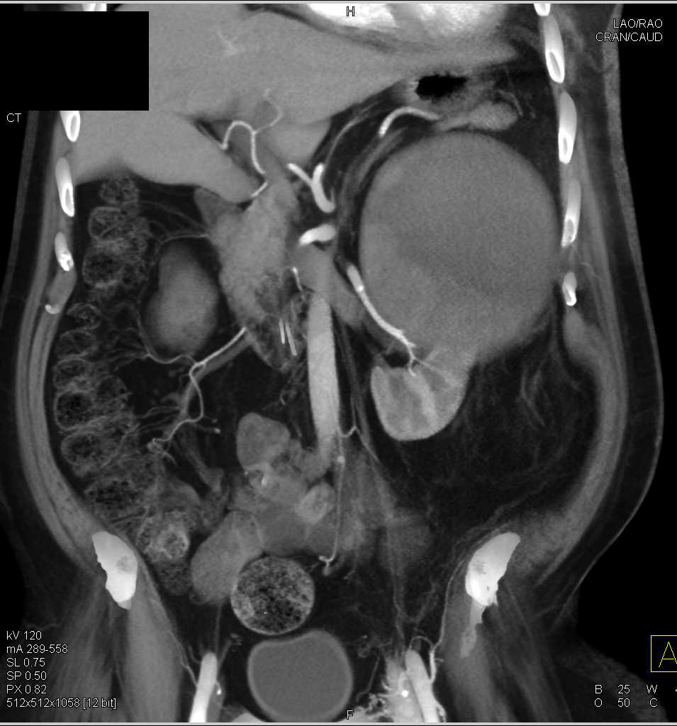 Cystic Left Renal Cell Carcinoma - CTisus CT Scan