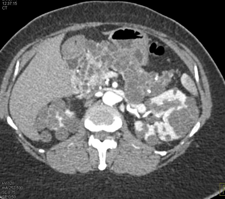 Multiple Bilateral Renal Cell Carcinomas and Cystic Pancreatic Lesions in a Patient with von Hippel Lindau Disease - CTisus CT Scan