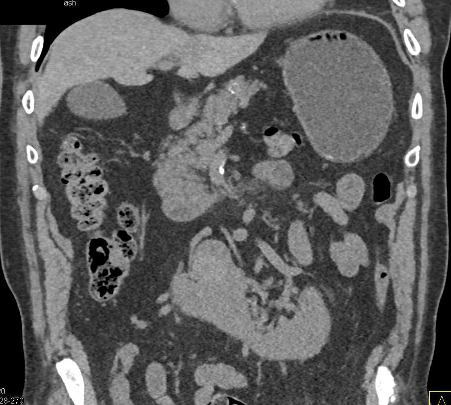 Renal Cell Carcinoma Arising in a Horseshoe Kidney - CTisus CT Scan