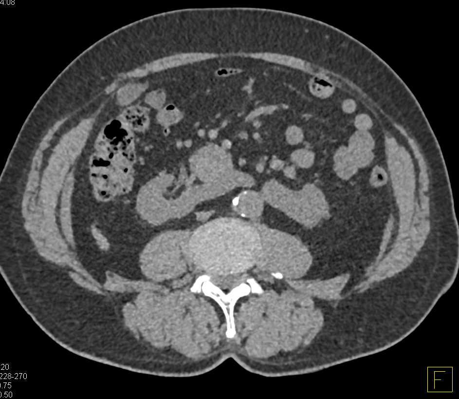 Renal Cell Carcinoma Arising in a Horseshoe Kidney - CTisus CT Scan