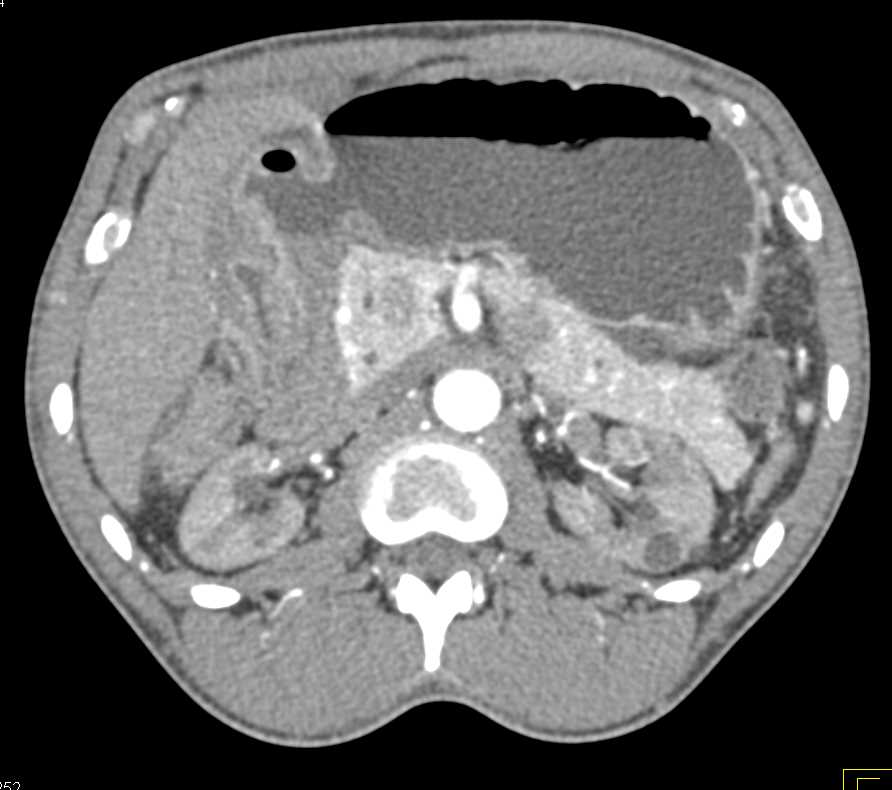 Multiple Small Renal Cysts - CTisus CT Scan