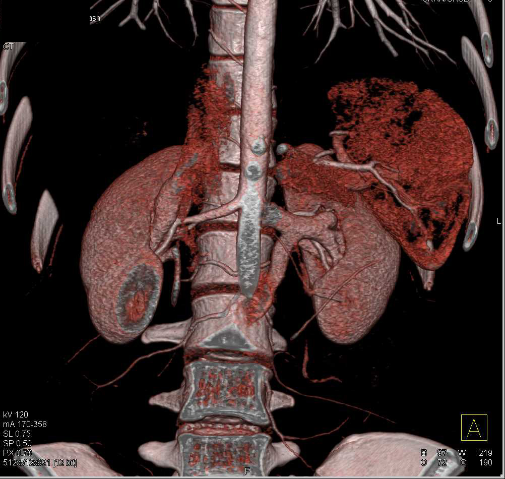 Circumaortic Left Renal Vein - CTisus CT Scan