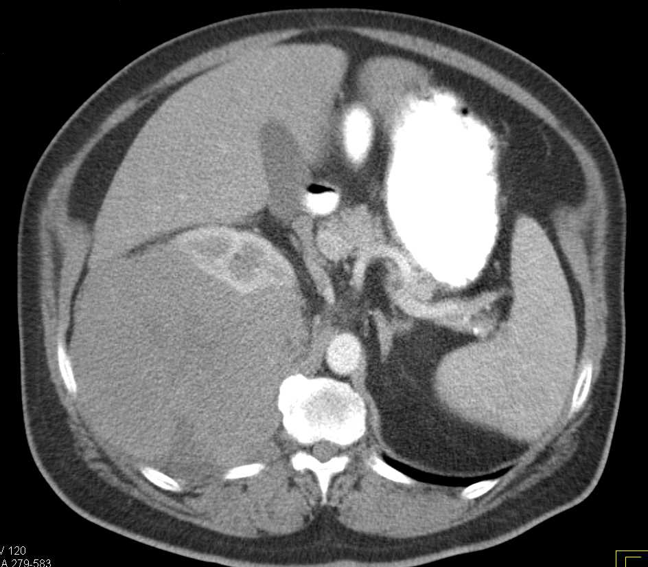 Subcapsular Hematoma Right Kidney - CTisus CT Scan