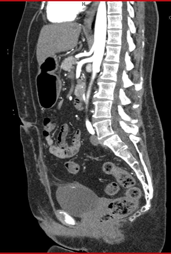 Transitional Cell Carcinoma Proximal Right Ureter - CTisus CT Scan