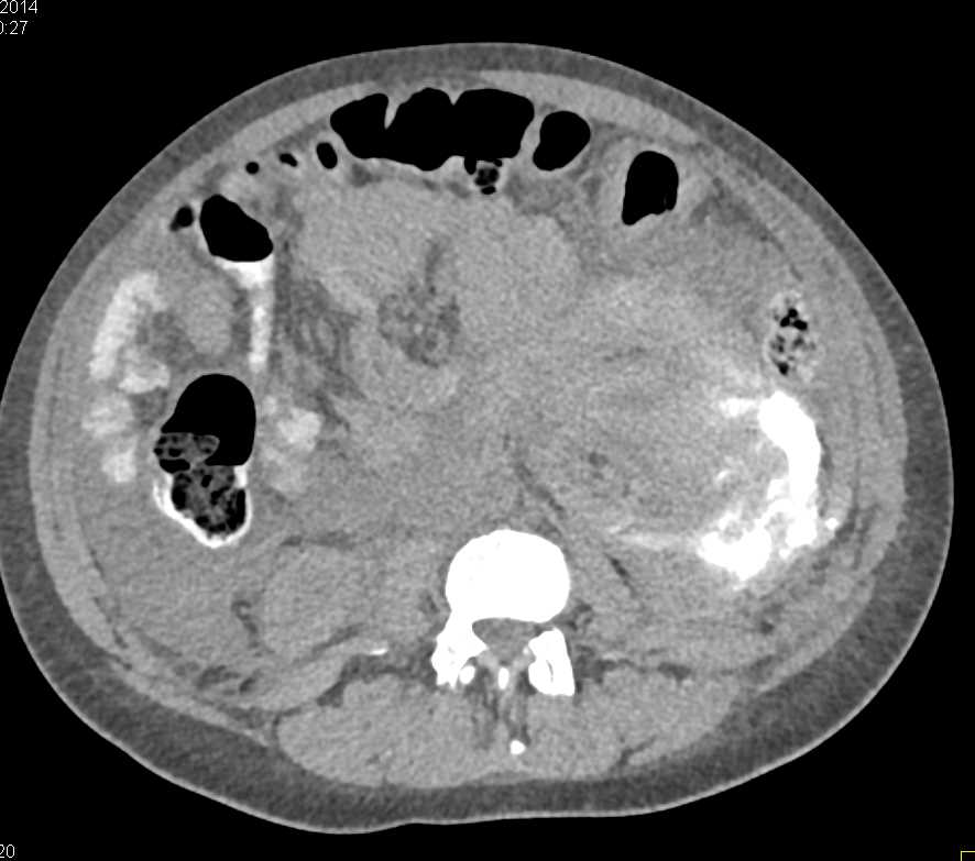 Left Renal Laceration and Contrast Extravasation - CTisus CT Scan