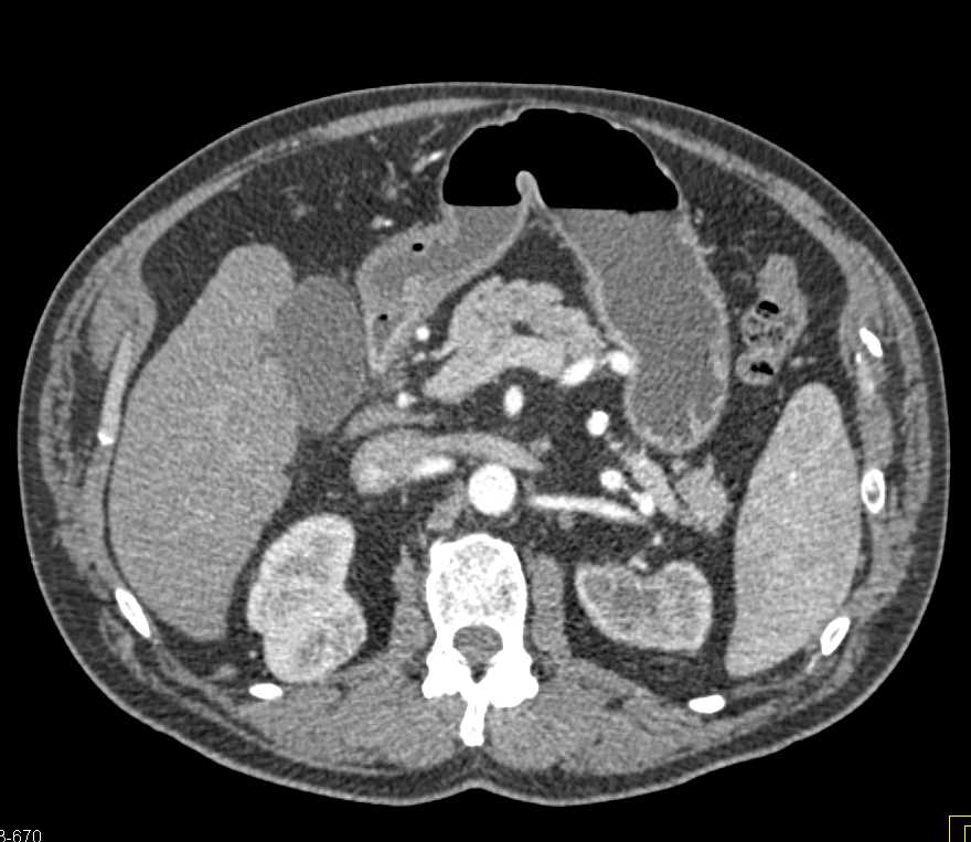 Renal Cell Carcinoma Right Kidney - CTisus CT Scan