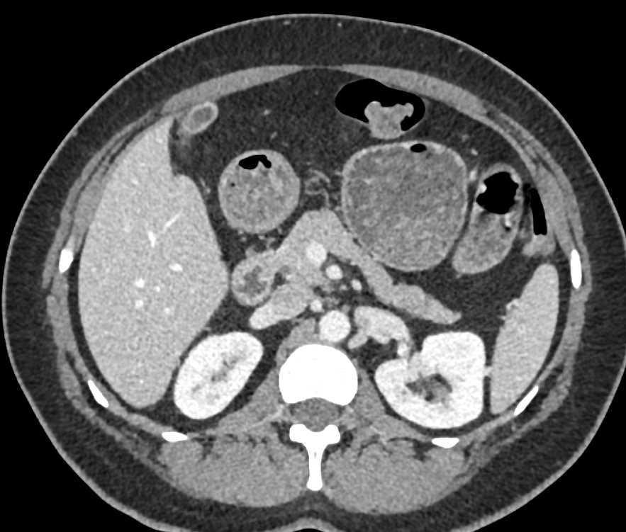 Cystic Left Renal Cell Carcinoma - CTisus CT Scan