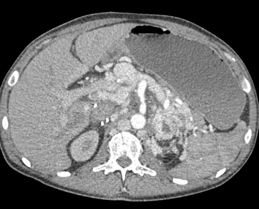 Recurrent Renal Cell Carcinoma with  Bone Metastasis - CTisus CT Scan