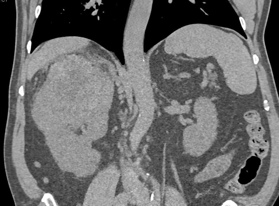 Clear Cell Renal Cell Carcinoma Right Kidney - CTisus CT Scan