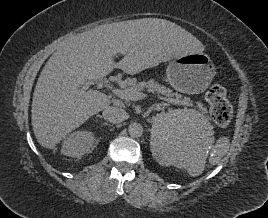 Acute Pyelonephritis Best Seen in the Left Kidney - CTisus CT Scan