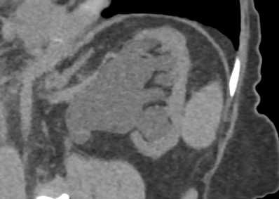 Obstruction Left Kidney at the Ureteropelvic Junction (UPJ) - CTisus CT Scan