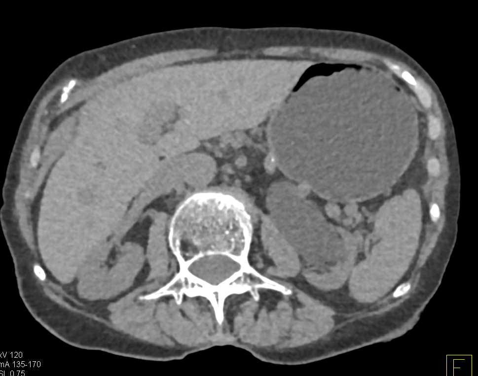 Obstruction Left Kidney at the Ureteropelvic Junction (UPJ) by a Small Transitional Cell Cancer (TCC) Best Seen on Oblique Images - CTisus CT Scan