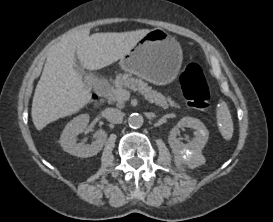 Papillary Renal Cell Carcinoma with Mild Enhancement and Calcifications - CTisus CT Scan