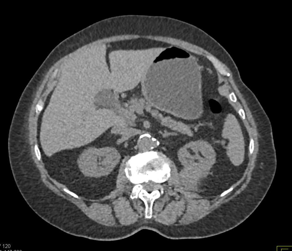 Papillary Renal Cell Carcinoma with Mild Enhancement and Calcifications - CTisus CT Scan