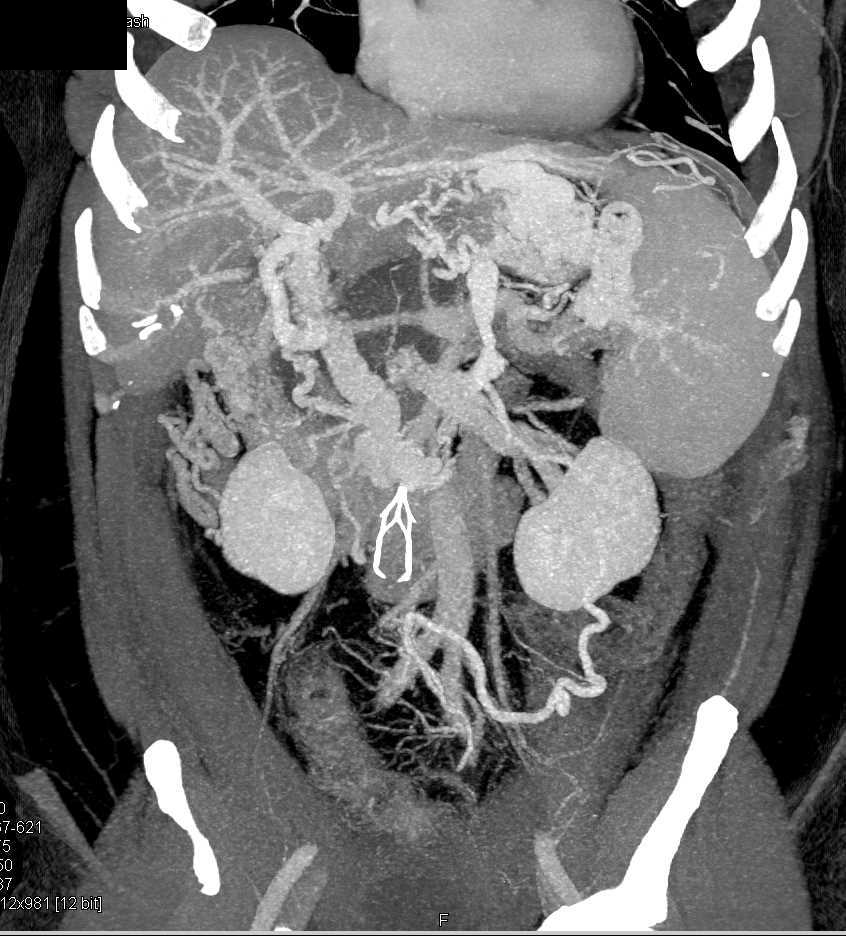 Incidental Left Renal Cell Carcinoma in Patient with a Pseudocyst - CTisus CT Scan