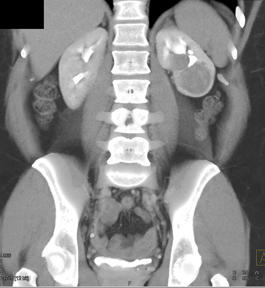 Papillary Left Renal Cell Carcinoma - CTisus CT Scan