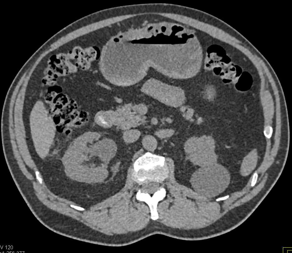 Bleed Lower Pole Right Kidney S/P Partial Nephrectomy - CTisus CT Scan