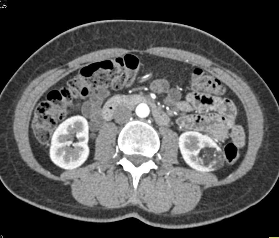 Angiomyelolipoma (AML) Left Kidney - CTisus CT Scan