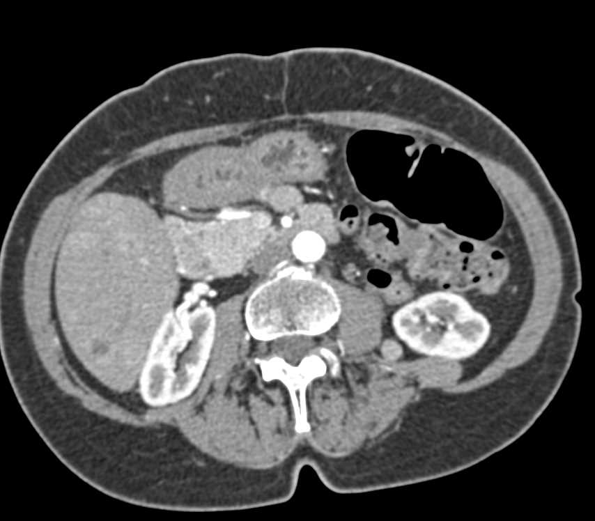 Metastatic Melanoma with Nodule Near the Left Kidney in Pararenal Space - CTisus CT Scan