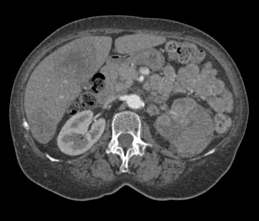 Renal Cell Carcinoma Left Kidney with Liver Metastases - CTisus CT Scan