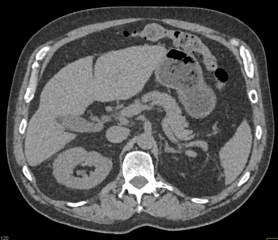 1 cm Recurrence Left Kidney S/P Partial Left Nephrectomy - CTisus CT Scan