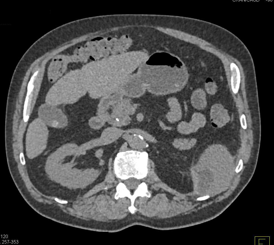 1 cm Recurrence Left Kidney S/P Partial Left Nephrectomy - CTisus CT Scan