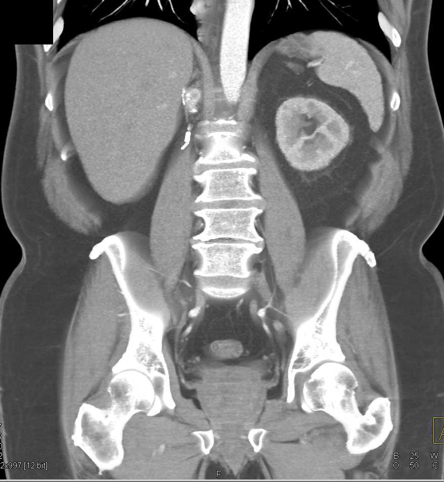 1cm Recurrence Near Right Renal Bed Following Nephrectomy for Clear Cell Renal Cell Carcinoma (RCC) - CTisus CT Scan