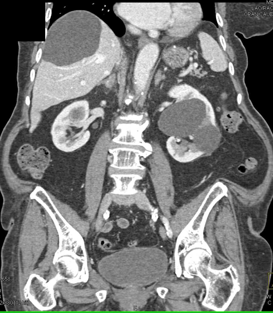 Papillary Renal Cell Carcinoma Left Kidney - CTisus CT Scan