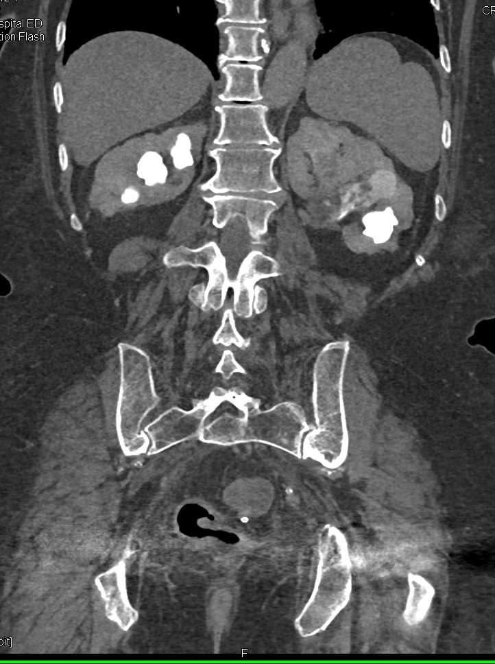 Multiple Blood Clots in Dilated Left Renal Pelvis and Ureter - CTisus CT Scan