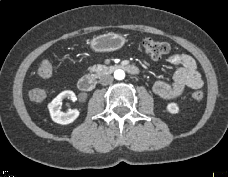 Incidental 1cm Right Renal Cell Carcinoma - CTisus CT Scan