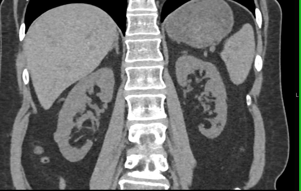 1cm Renal Cell Carcinoma Right Kidney - CTisus CT Scan