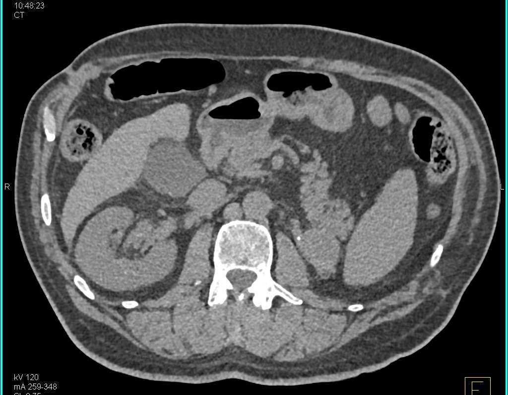 Recurrent Renal Cell Carcinoma to Contralateral Kidney and Left Iliopsoas Muscle - CTisus CT Scan