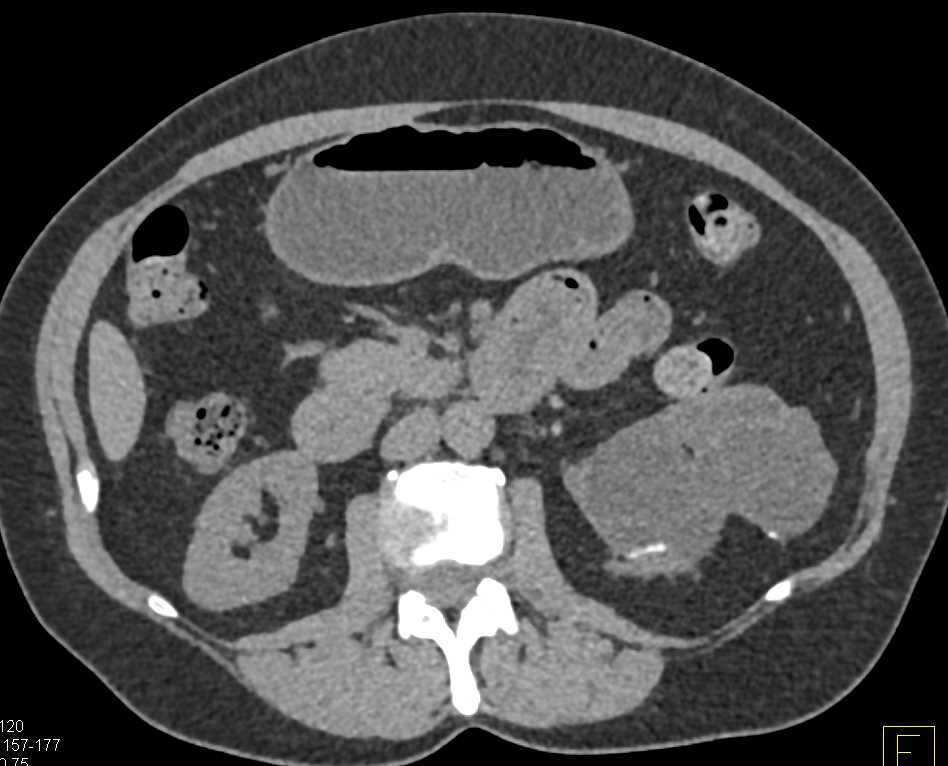 Bosniak 2F Cyst Left Kidney - CTisus CT Scan