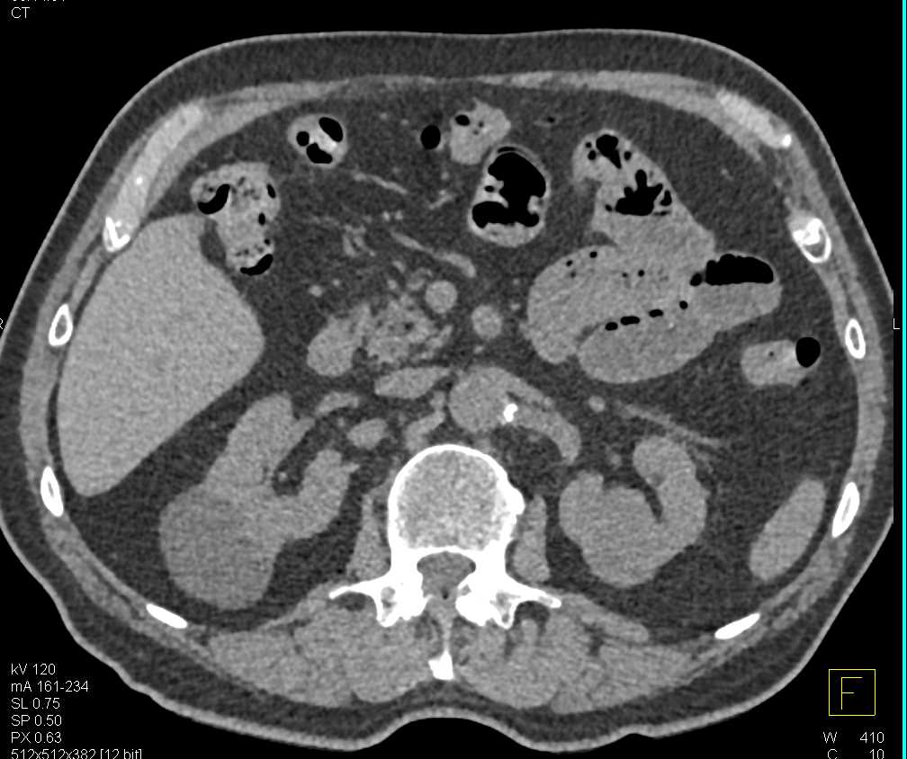 Papillary Renal Cell Carcinoma Left Kidney - CTisus CT Scan