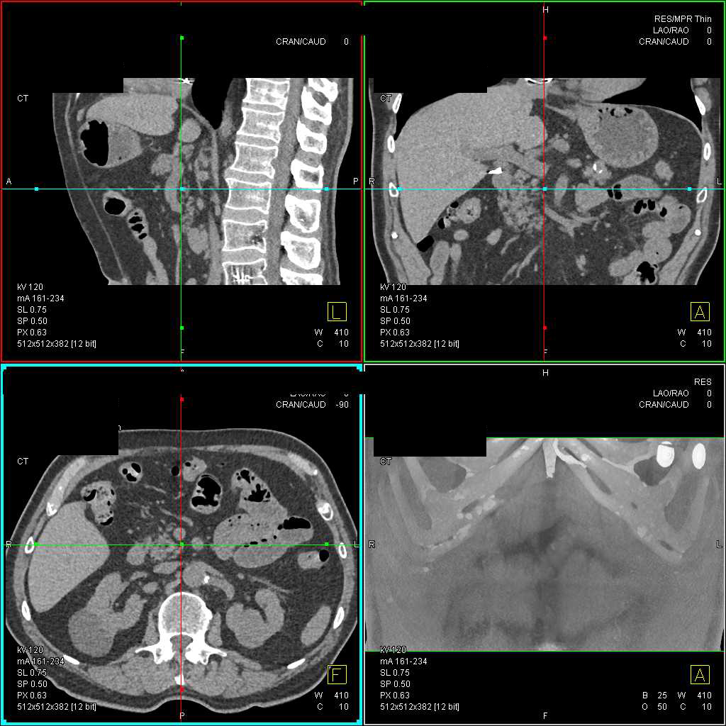 Papillary Renal Cell Carcinoma Left Kidney - CTisus CT Scan