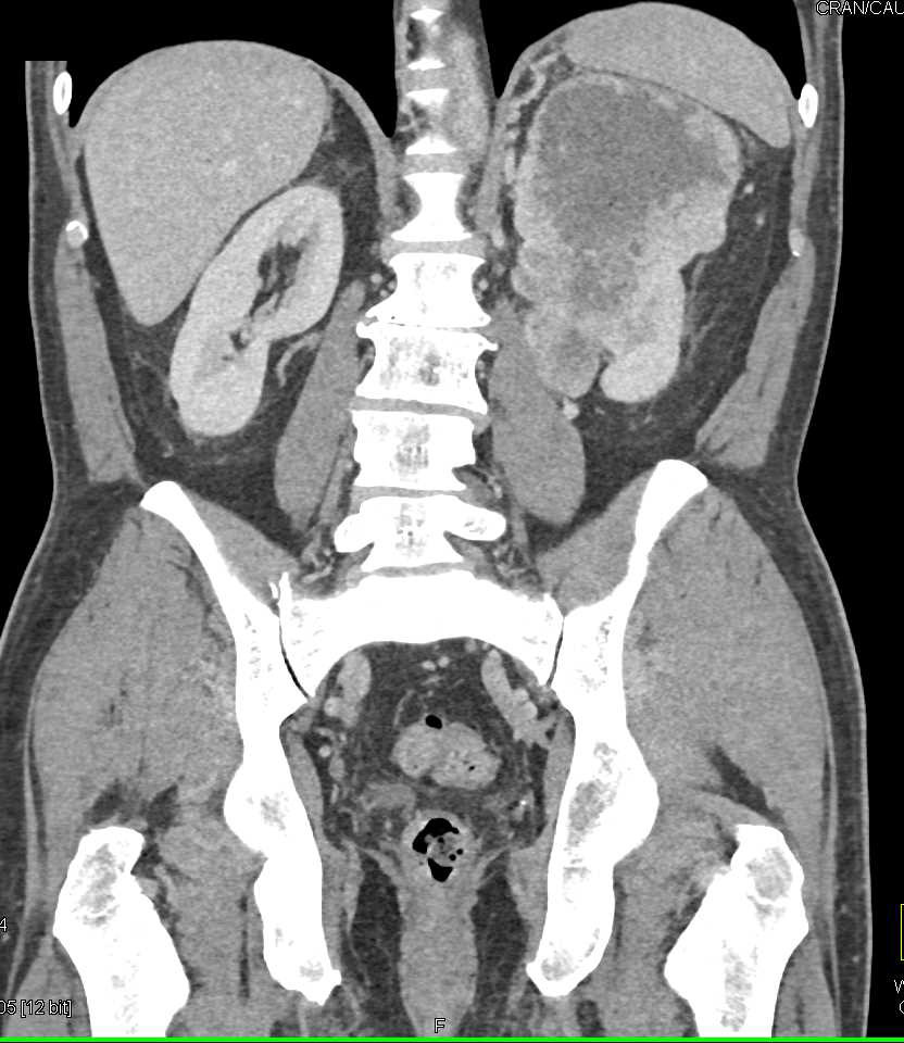 Vascular Renal Cell Carcinoma - CTisus CT Scan