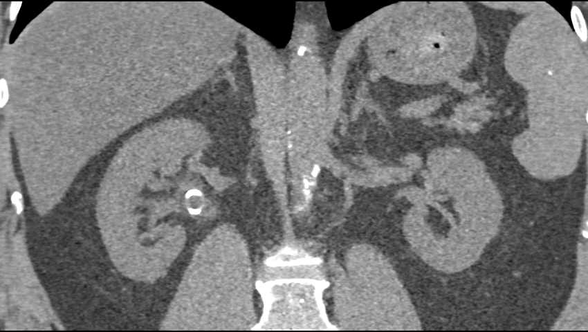 Transitional Cell Cancer (TCC) Right Renal Pelvis, Ureter and Bladder - CTisus CT Scan