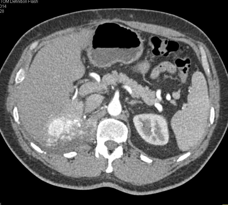 Recurrent Renal Cell Carcinoma to Liver and Beyond - CTisus CT Scan