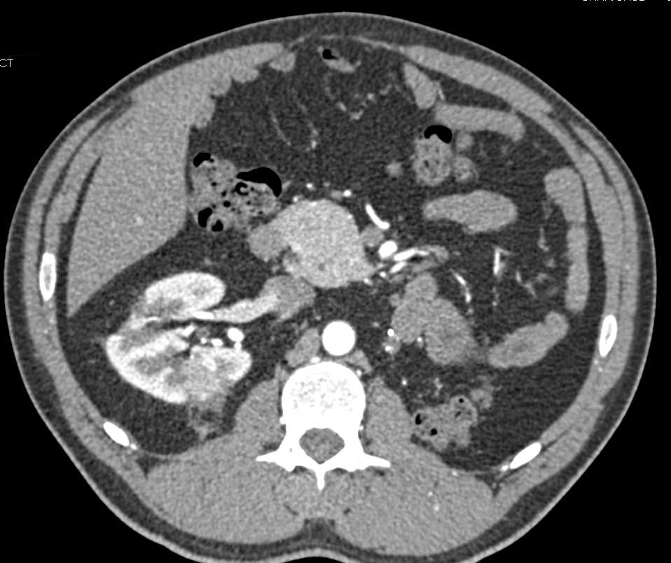 Multiple Ablation Changes Kidney - CTisus CT Scan