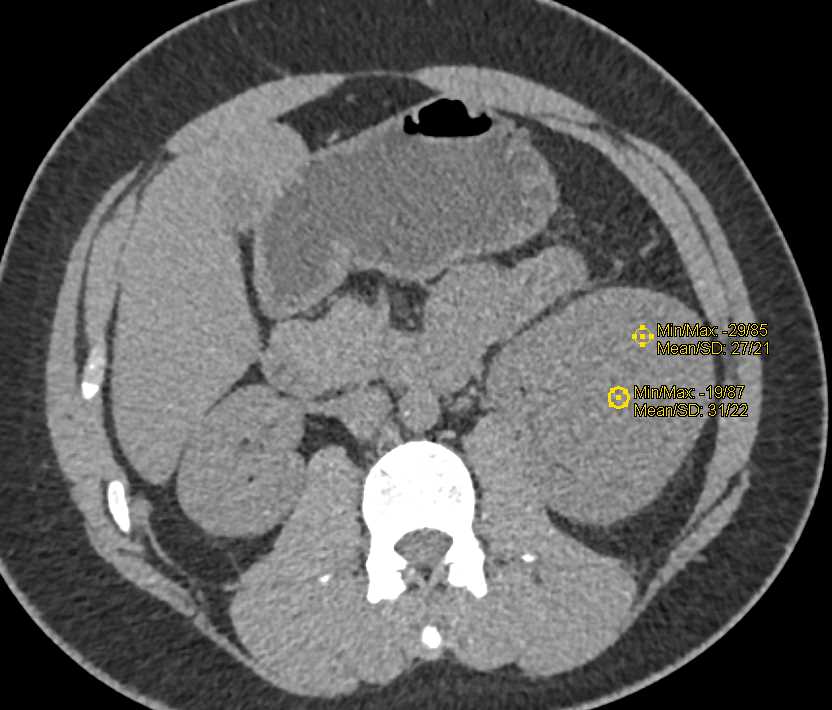 Papillary Renal Cell Carcinoma Looks Like a High Density Renal Cyst but it Enhances Over 30HU - CTisus CT Scan