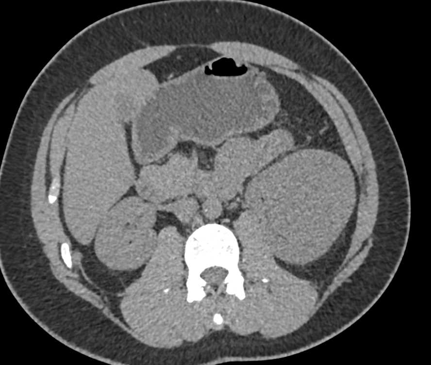 Papillary Renal Cell Carcinoma Looks Like a High Density Renal Cyst but it Enhances Over 30HU - CTisus CT Scan