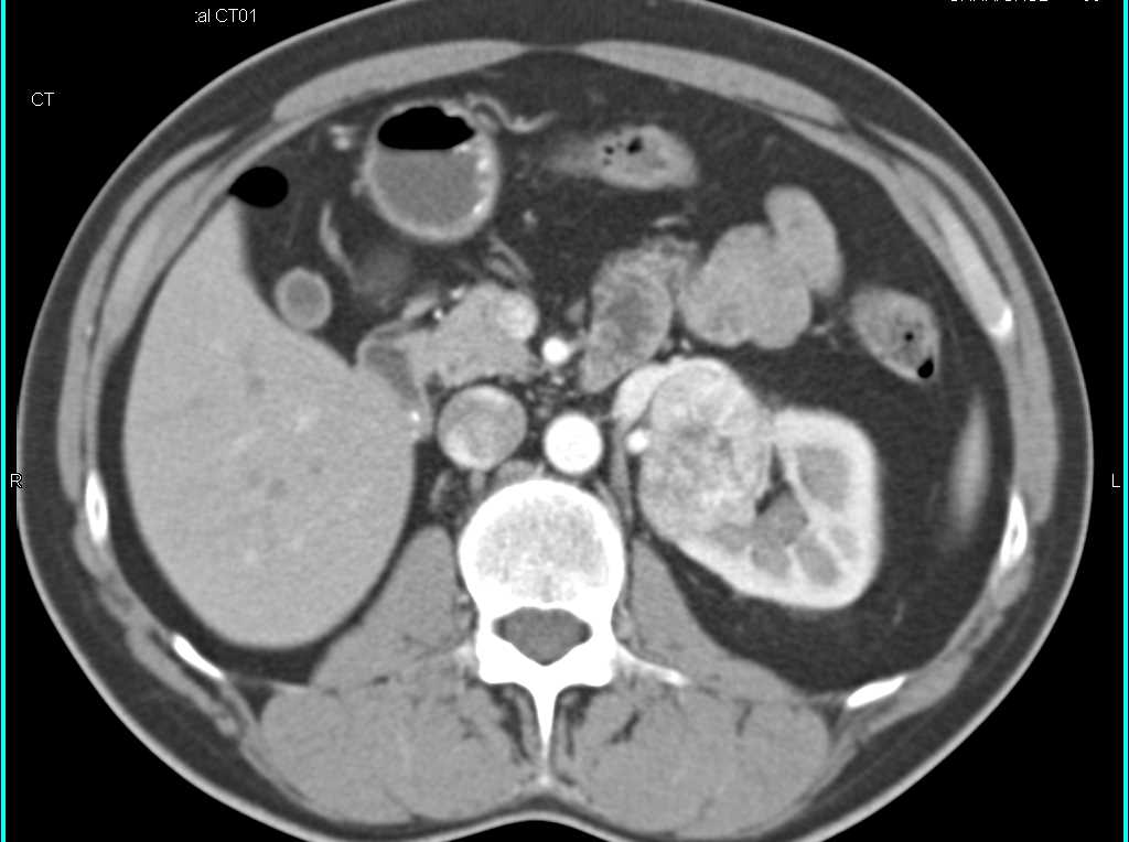 Medullary Renal Cell Carinoma - CTisus CT Scan