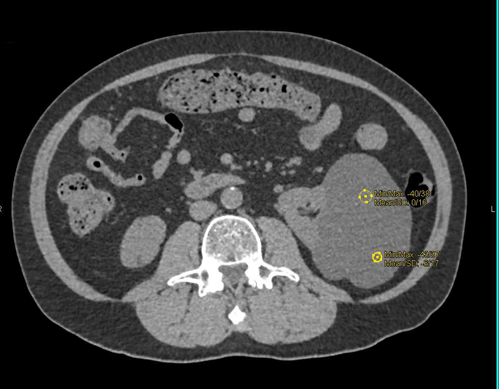 Bosniak I Renal Cyst Left Kidney - CTisus CT Scan