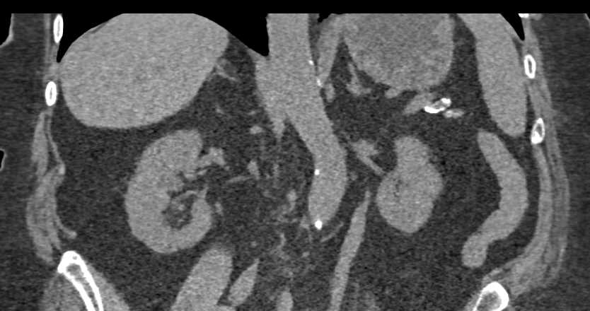 Transitional Cell Carcinoma Left Renal Pelvis - CTisus CT Scan