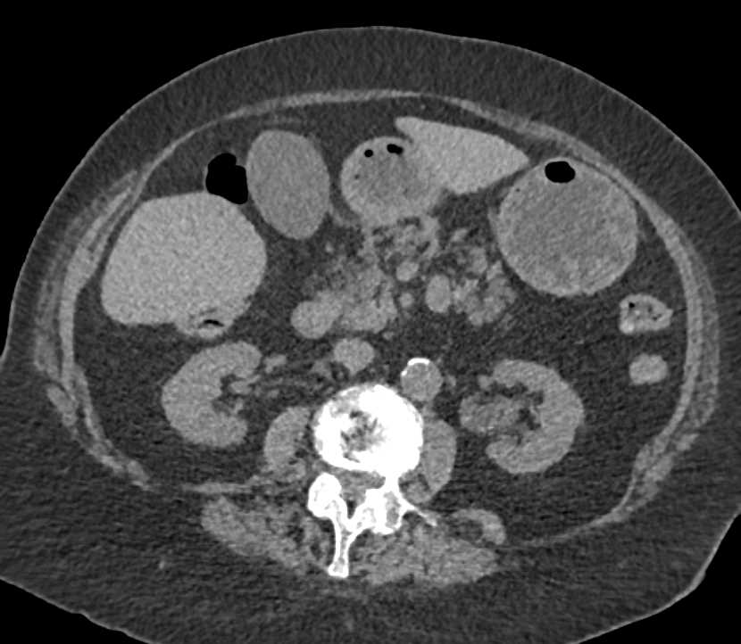 Transitional Cell Carcinoma Left Renal Pelvis and Left Ureter in 3D - CTisus CT Scan